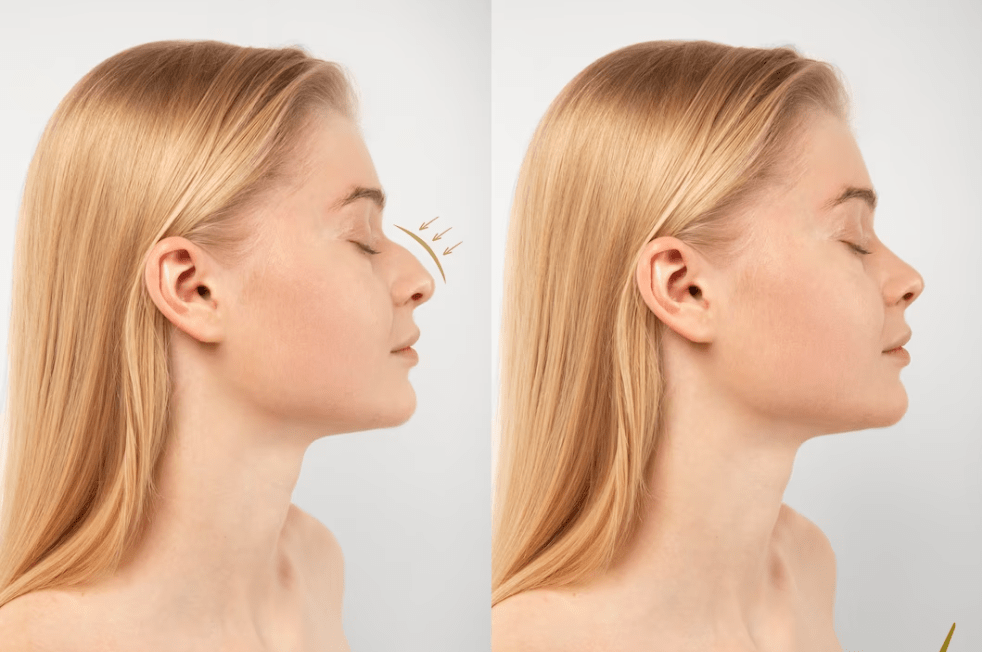 Burun Estetigi Hakkinda Adan Zye Her Sey 2